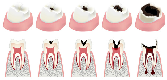 一般的な虫歯の治療回数の平均はどのくらい 歯科コラム 公式 フォレストデンタルクリニック西新宿院 新宿区 西新宿駅